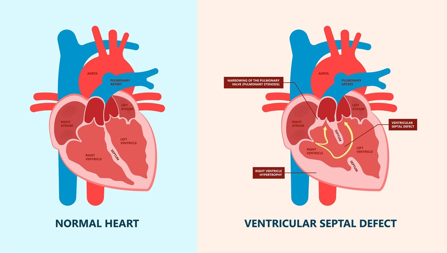 Diagram showing Normal Heart vs. Ventricular Septal Defect in Children